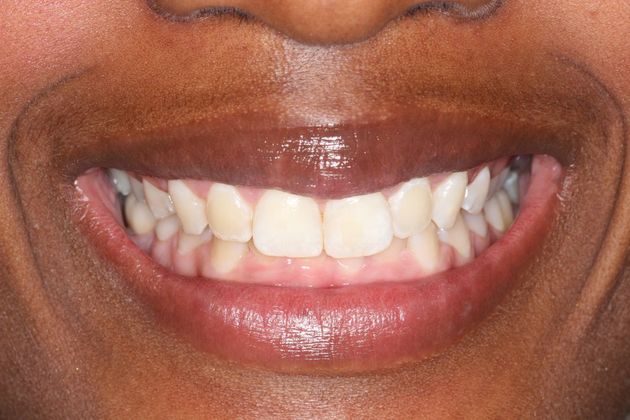 after smile makeover